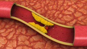 artery-cp-584.jpg